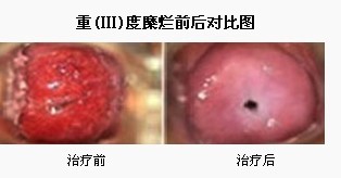 宫颈糜烂治疗前后对比