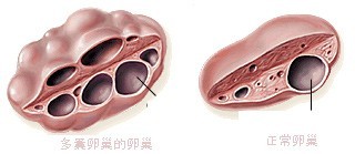 多囊卵巢