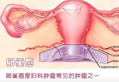 女性肠胃不适 需警惕卵巢癌侵袭