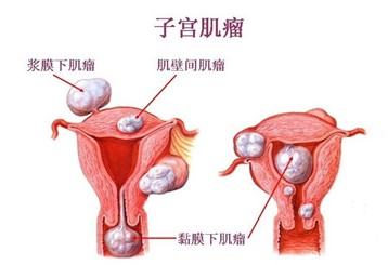 子宫肌瘤治疗需及时，拖到绝经未必好