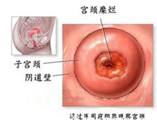 宫颈糜烂成女性“健康杀手”，防不胜防