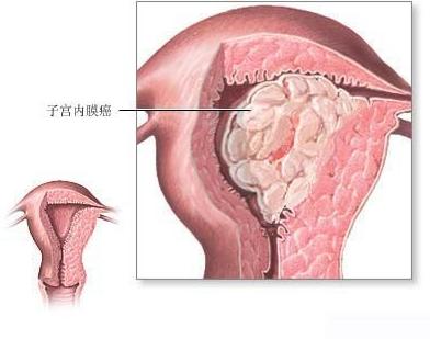 绝经后阴道出血，需警惕子宫内膜癌