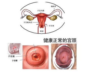 真相：太爱“干净”也会引起宫颈糜烂